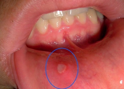7 dấu hiệu bất thường ở miệng cảnh báo cơ thể thiếu magie