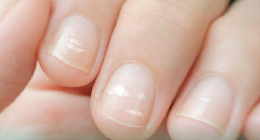 Dấu hiệu trên móng tay cảnh báo bệnh tật