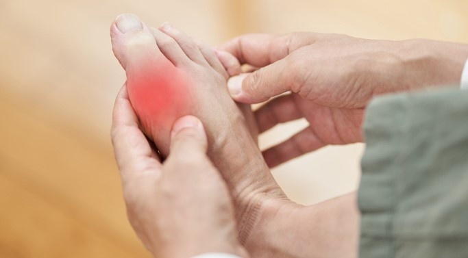 5 nguyên nhân phổ biến gây ra nồng độ axit uric cao