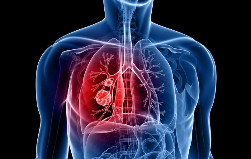 5 dấu hiệu liên quan đến ung thư phổi không nên bỏ qua