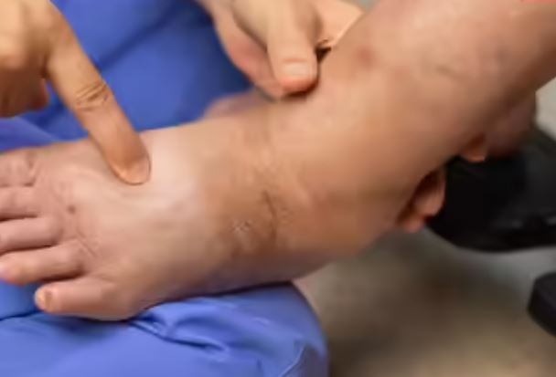 Nhận diện tình trạng sưng ở chân đối với sức khỏe