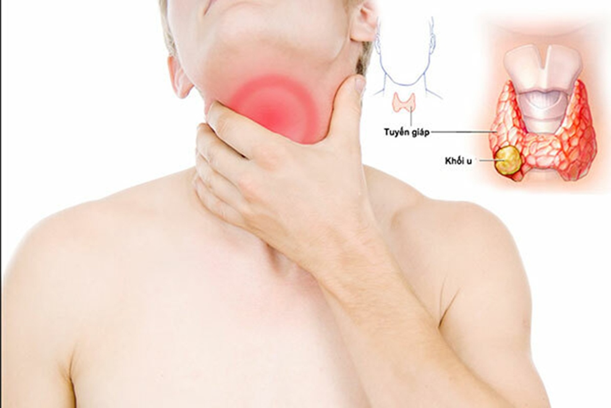 Hình minh họa của Bệnh viện Bạch Mai Hình minh họa của Bệnh viện Bạch Mai
