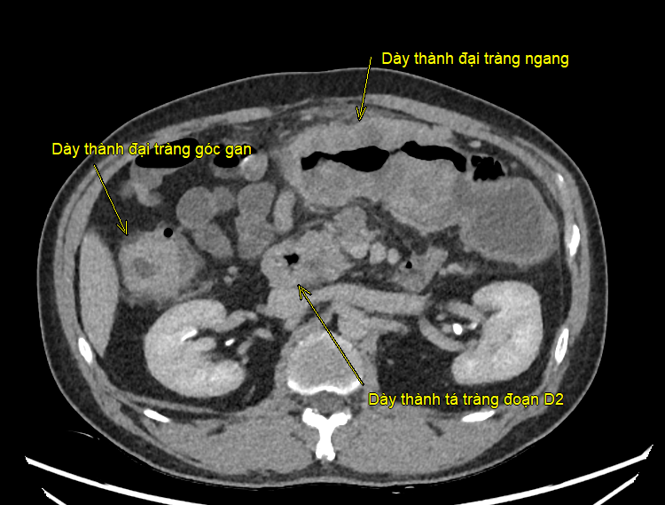 Ca đại phẫu kéo dài hơn 8 giờ giải cứu bệnh nhân mắc ung thư kép