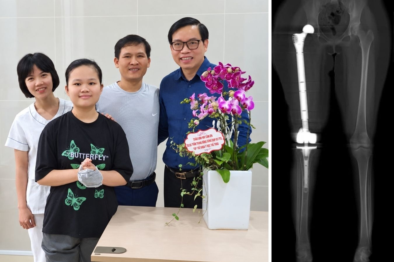 Hình ảnh GS.TS.BS Trần Trung Dũng bên Linh Nhi cùng gia đình (trái) và ca đại phẫu thay toàn bộ xương đùi Titan in 3D năm 2021 (phải) giúp Linh Nhi giữ lại đôi chân. (Ảnh: Gia đình cung cấp) Hình ảnh GS.TS.BS Trần Trung Dũng bên Linh Nhi cùng gia đình (trái) và ca đại phẫu thay toàn bộ xương đùi Titan in 3D năm 2021 (phải) giúp Linh Nhi giữ lại đôi chân. (Ảnh: Gia đình cung cấp)